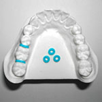 Orthodontal model of lower teeth with spacers installed and three laid sideways for size reference