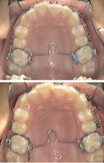 A view of the roof of a mouth from the bottom with Transpalatal Arch installed